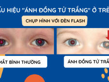 DẤU HIỆU ÁNH ĐỒNG TỬ TRẮNG Ở TRẺ EM